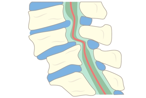 脊柱管狭窄症の画像